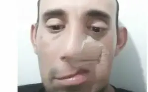 Doação Tratamento Cancer Raro No Rosto