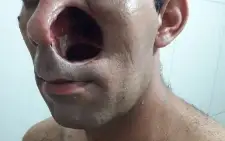 Doação Tratamento Cancer Raro No Rosto