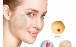 Neatcell Caneta Laser Remover Tatuagem Luz Vermelha