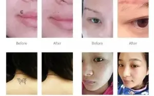 Neatcell Caneta Laser Remover Tatuagem Luz Vermelha