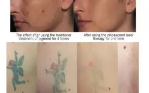 Neatcell Caneta Laser Remover Tatuagem Luz Vermelha