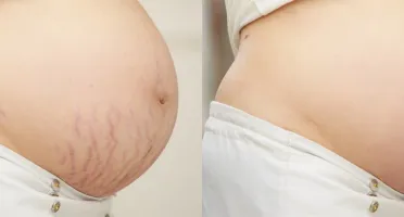 Remoção de Fundo e Edição de Fotos
