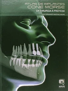 Atlas de Implantes Cone Morse. Da Cirurgia à Prótese - eBooks