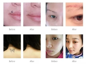 Neatcell Caneta Laser Remover Tatuagem Luz Vermelha - Products