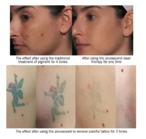 Neatcell Caneta Laser Remover Tatuagem Luz Vermelha - Produtos Físicos